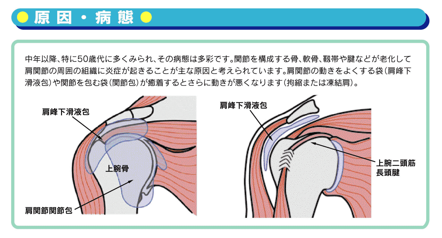 日本整形外科学会　五十肩　肩の内部